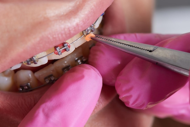 Dental procedure for installing braces close upthe procedure for the care of teeth and gums in the m