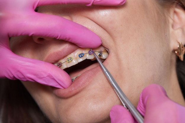 Dental procedure for installing braces close upthe procedure for the care of teeth and gums in the m