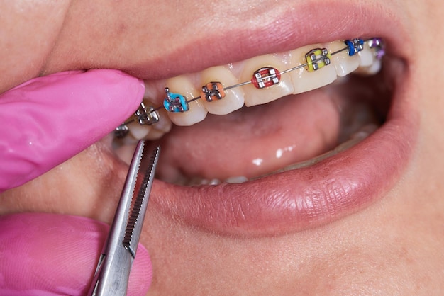 Dental procedure for installing braces close upthe procedure for the care of teeth and gums in the m