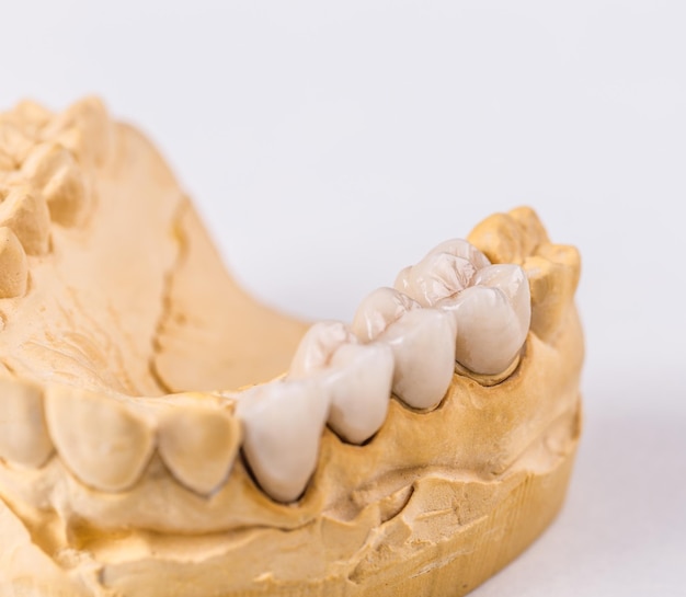 Dental prosthesis