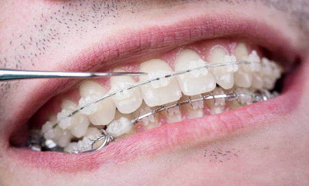 Dentist checking up teeth with ceramic brackets using probe at the dental office. Macro shot of teeth with braces. Orthodontic Treatment. Dentistry