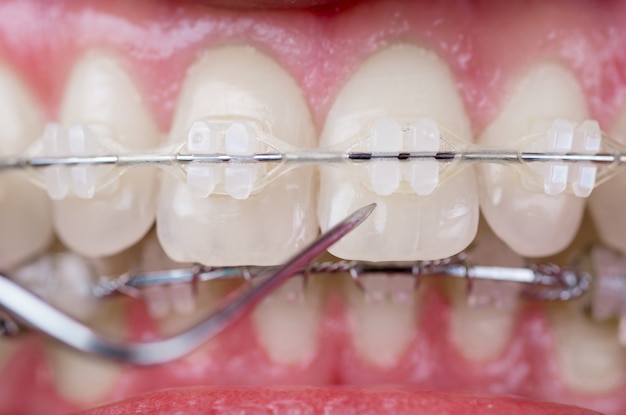 Dentist checking up teeth with ceramic brackets using probe at the dental office. Macro shot of teeth with braces