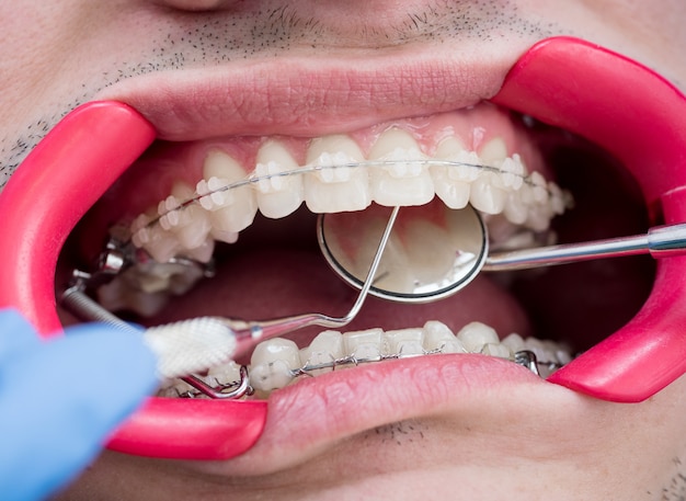 Dentist holding probe and mirror and checking up teeth with brackets at the dental office