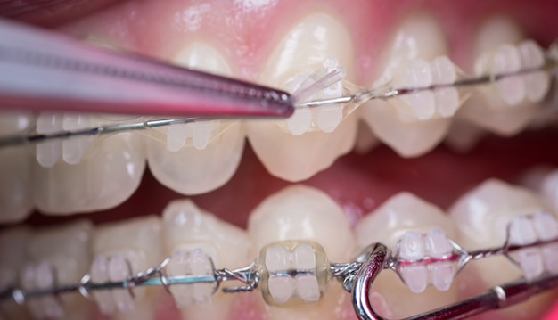 Dentist treating teeth with ceramic brackets, using mosquito at the dental office.