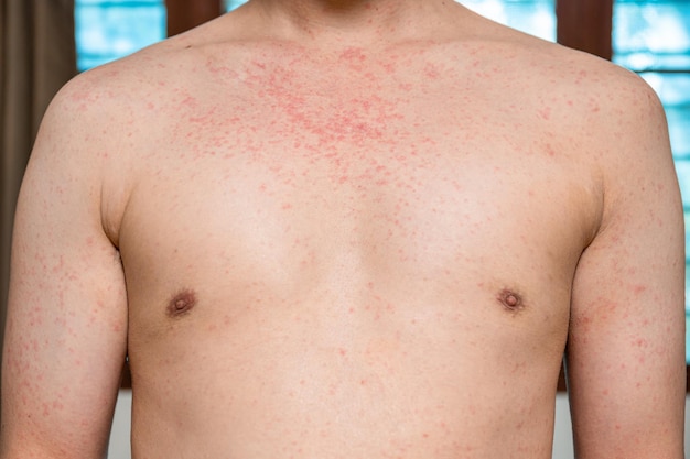 Dermatitis rash viral disease with immunodeficiency on body of young adult asian, scratch with itch, Measles Virus, Viral Exanthem