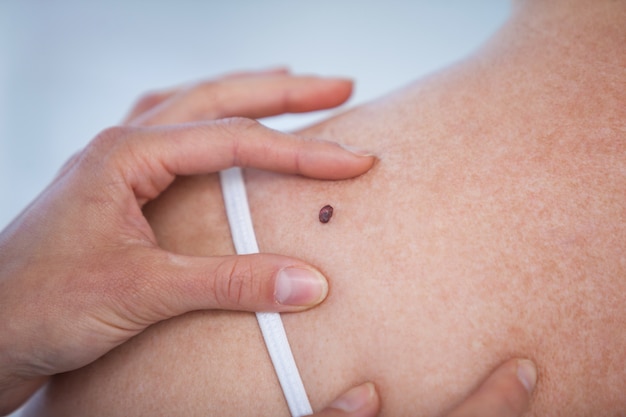 Dermatologist examines a mole of female patient