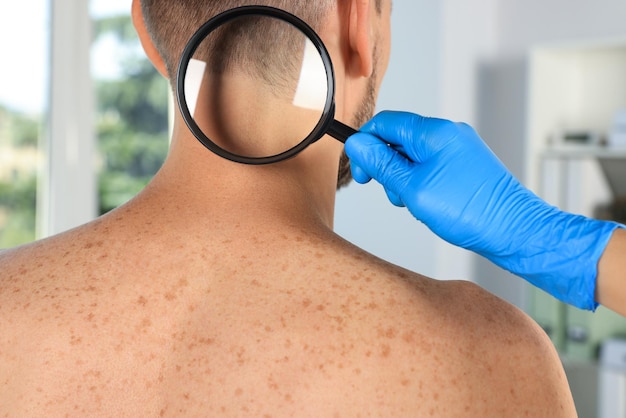 Dermatologist examining patient39s birthmark with magnifying glass in clinic closeup