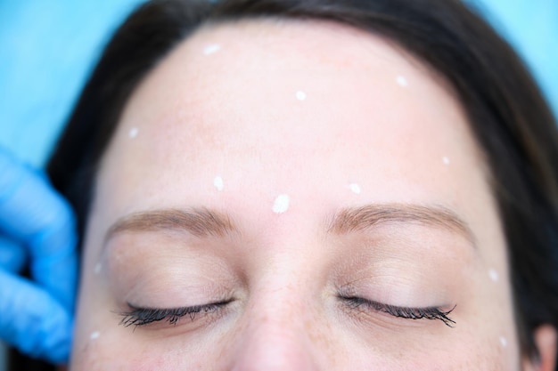 Detail of the forehead of a girl who has been marked with a white dermographic pencil for botulinum toxin injection