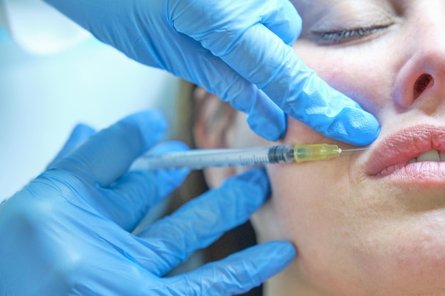 Detail of hands with syringe injecting botulinum toxin in the upper lip of a girl to get a Russian lip