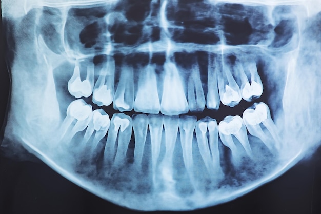 Photo detailed dental xray revealing tooth alignment and health