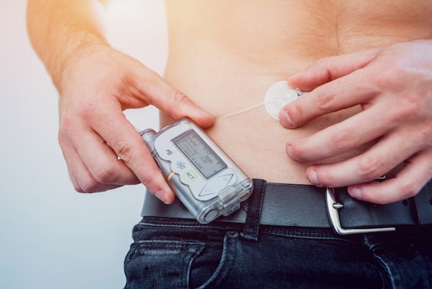 Diabetic man with an insulin pump connected in his abdomen and keeping the insulin pump on his belt.