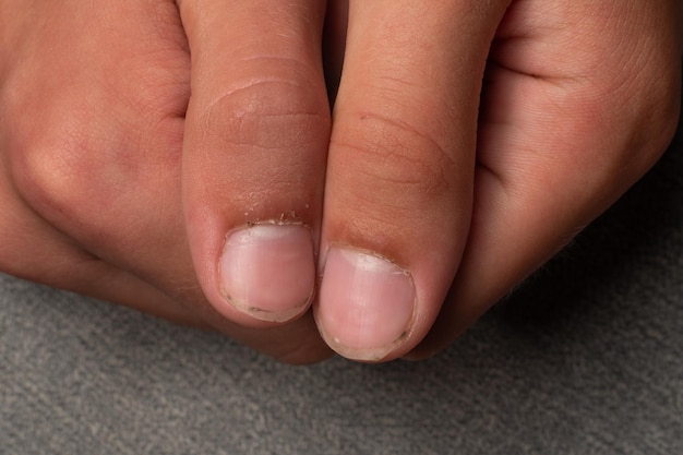 Dirty and long nails with burrs fingers and fingernails of a child on a gray background