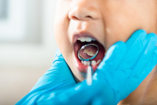 Doctor examines oral cavity of little child uses mouth mirror to checking teeth cavity