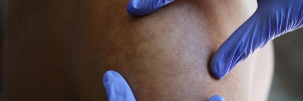 Photo doctor examines skin disease of his patient closeup dermatologist in gloves examines patient