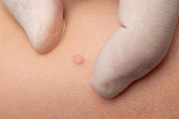 A doctor examines a wart on a child's body