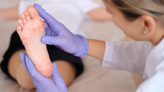 Doctor examining foot of child with red itchy rashes in clinic closeup