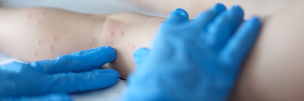 Photo doctor examining red rash on legs of child in clinic closeup