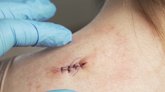 Photo doctor hands checking stitches after mold removal surgery on woman shoulder.