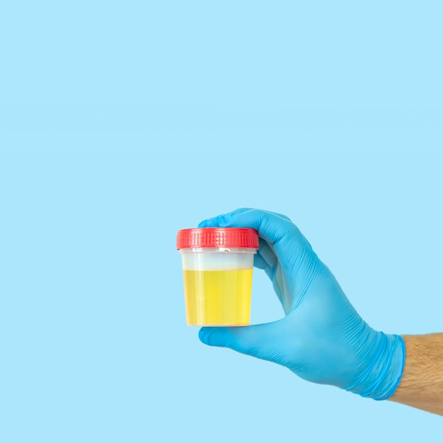 Doctor holding urine sample container for medical urinalysis