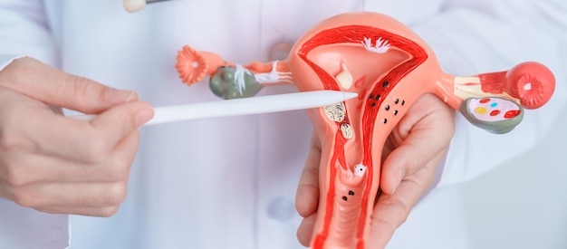 Doctor holding Uterus and Ovaries model Ovarian and Cervical cancer Cervix disorder Endometriosis Hysterectomy Uterine fibroids Reproductive system and Pregnancy concept