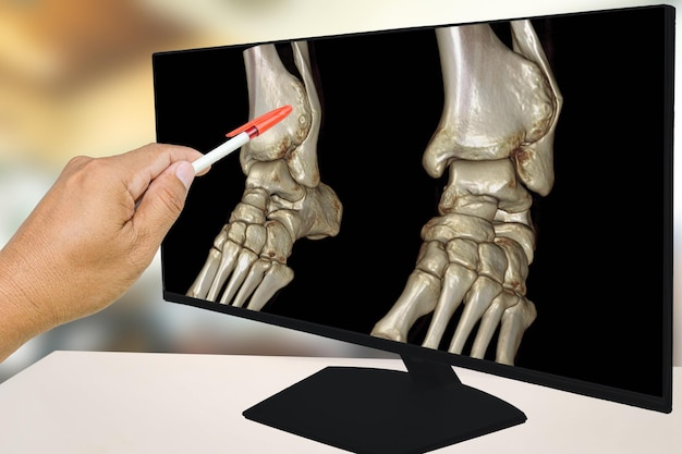 The doctor informed the results of xray images of the ankle and found distal tibia bone abnormalities distal tibiofibular syndesmosis injury by the doctor pointing to the position on the LCD screen