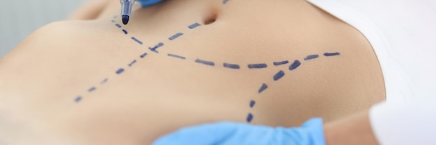 Doctor plastic surgeon drawing preoperative markings on skin of patient abdomen closeup