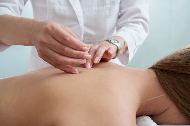 Doctor puts needles into female back on the acupuncture treatment therapy in spa salon alternative