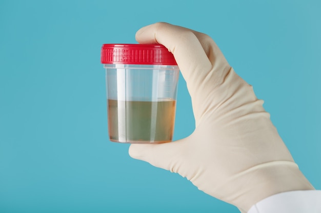 doctor's gloved hand holds a transparent container with a urine test