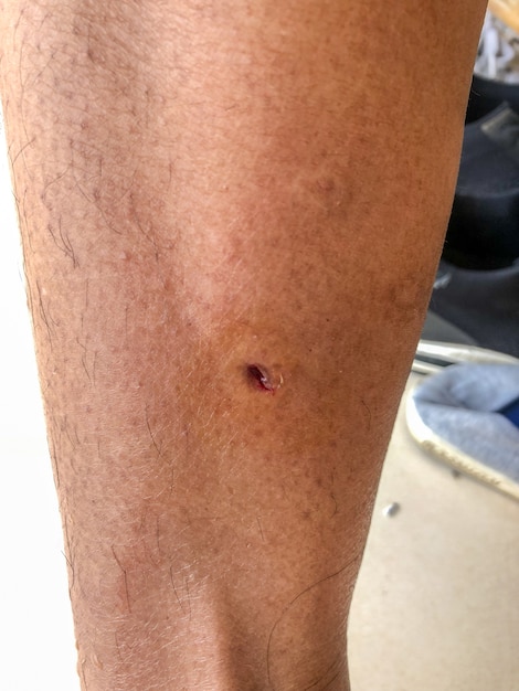 Dog bite wounds on calf leg