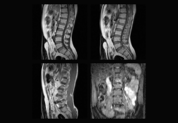 Dorsal Spine MRI and ct scan professional xray images