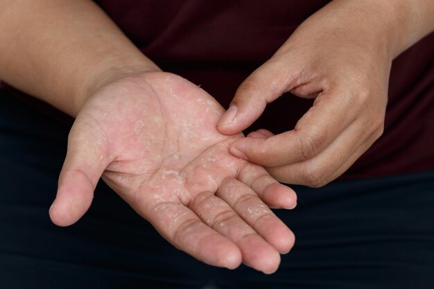 Photo dry hands peeling skin on hand and fingers air allergy chemical allergydermatitis eczemaxaxa