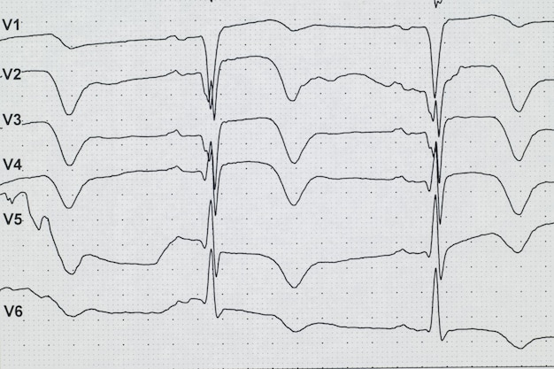 ECG Myocardial infarctionon ECG AnginaChest pain Closeup