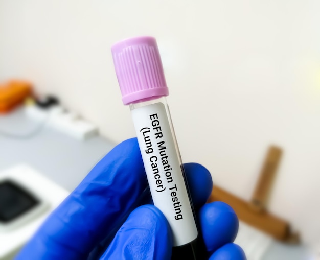 EGFR mutation test for the diagnosis of lung disease. Epidermal Growth Factor Receptor.