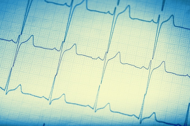 Photo ekg graph.electrocardiogram ekg ecg.