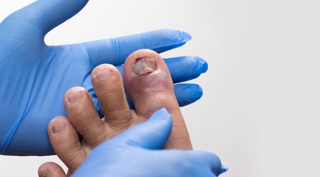 Examination by a doctor on bruised toenail