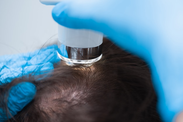 Examination of the patient's scalp with a trichoscope. Trichoscopy of hair follicles.