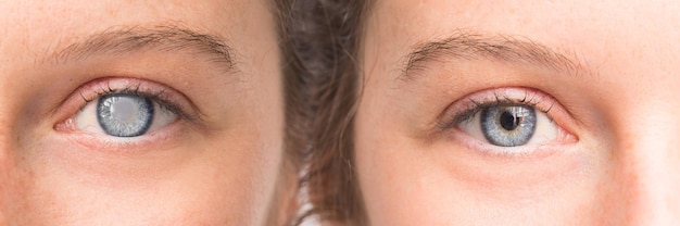 Eye before and after surgery with and without cataract