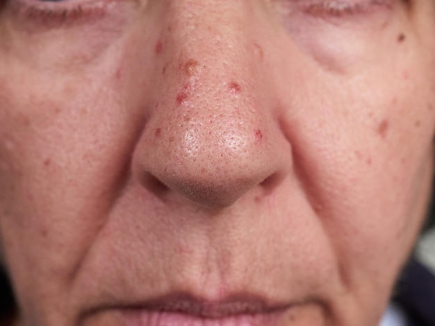 Face of a woman with cherry angiomas in her nose