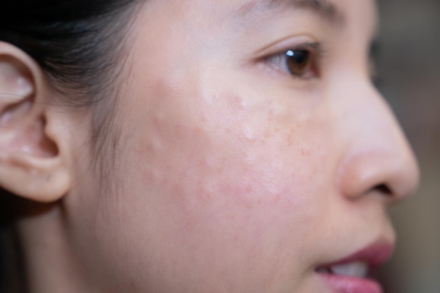 Female face with dots facial spots after beauty injections Rejuvenation procedure beautician mesotherapy pattern skin care