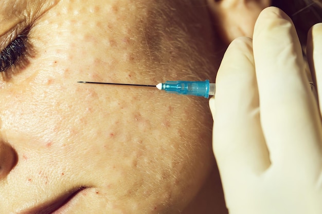 Female with pimples and syringe