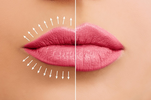 Photo fillers lip augmentation beautiful pink lips