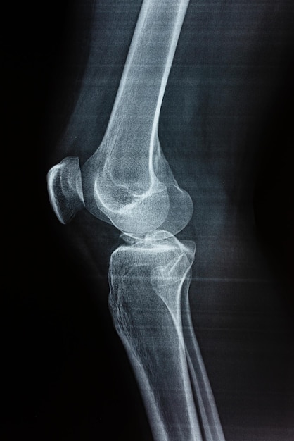 Film Xray of a leg bone person Film grain style