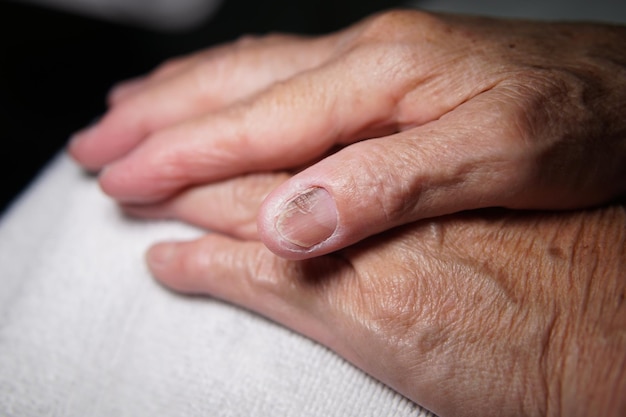 Fingernail of an elderly woman infected with fungal infection