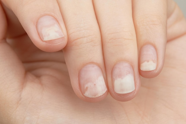 Fingernails with onycholysis after removing gel polish womans hands with damaged nails