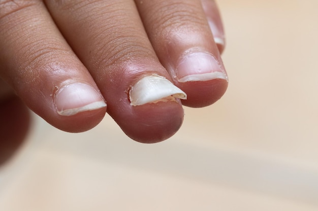 Fingers of a child who is losing a fingernail