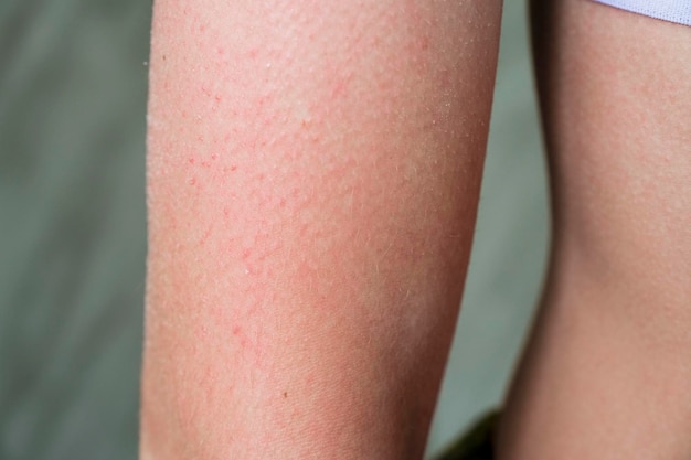 Follicular hyperkeratosis is located on the person's arm.