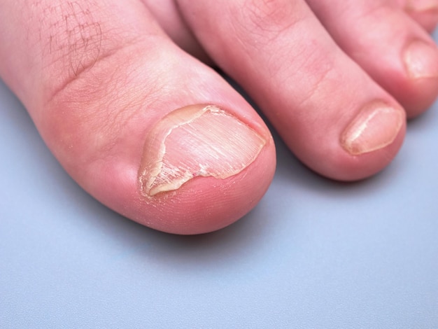 Foot of a young boy with weak or brittle nails onychoschizia disease isolated on gray background extreme close up look