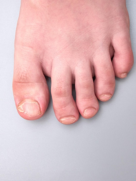 Foot of a young boy with weak or brittle nails onychoschizia disease