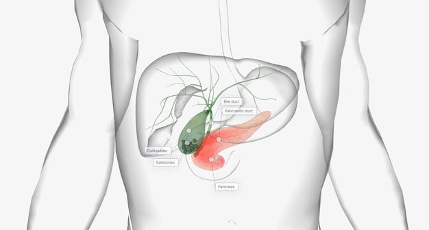 Photo gallstones are pieces of solid material that form in the gallbladder a small hollow organ located beneath the liver