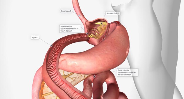 Photo a gastric bypass is a surgery designed to help patients lose weight